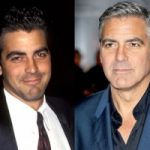 George Clooney Plastic Surgery Before and After