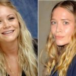 Mary-Kate Olsen Plastic Surgery Before and After