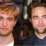 Robert Pattinson Plastic Surgery Before and After
