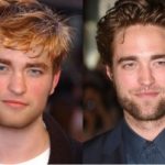 Robert Pattinson Plastic Surgery Before and After