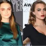 Cara Delevingne Plastic Surgery Before and After