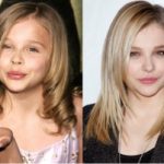 Chloë Grace Moretz Plastic Surgery Before and After